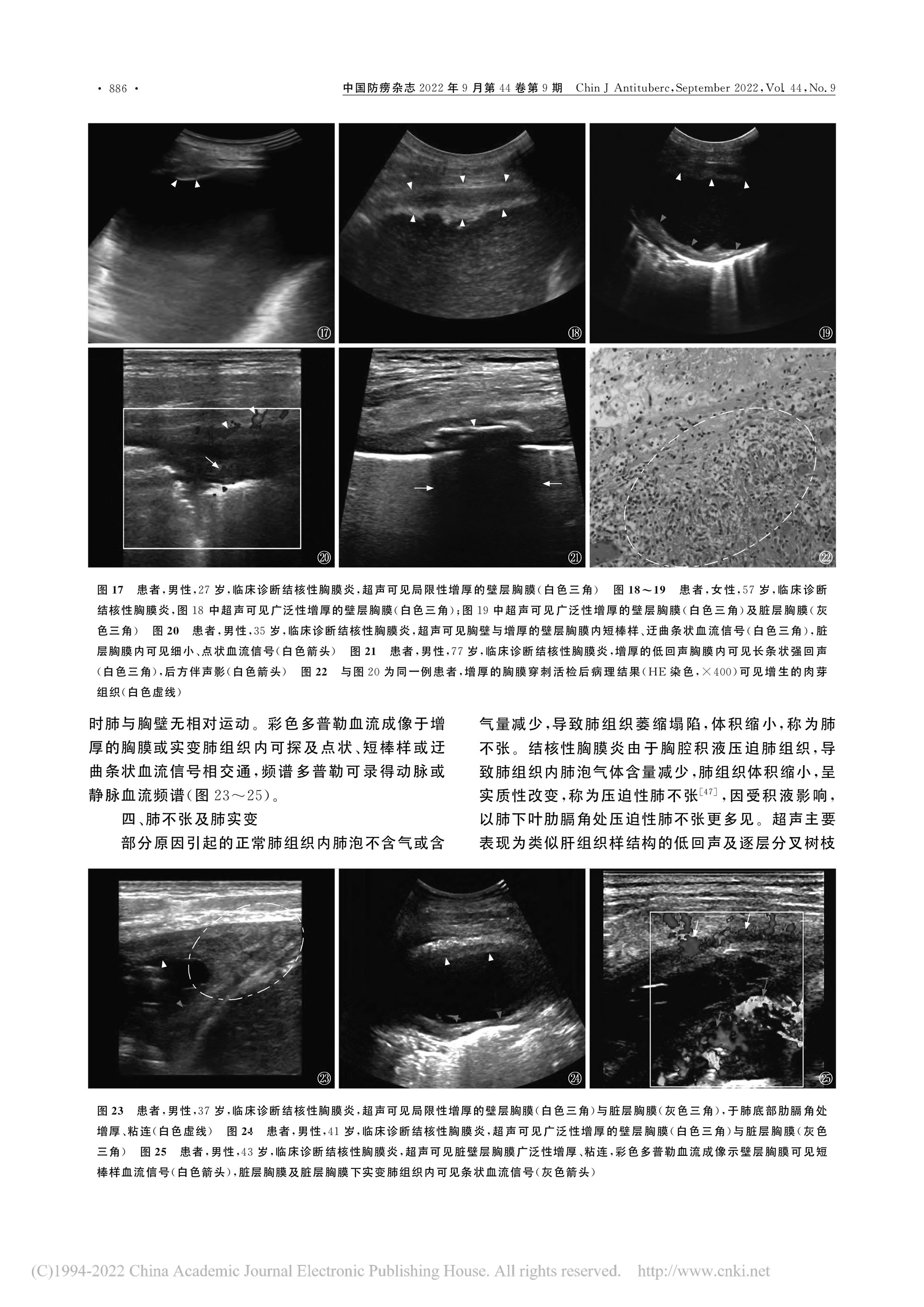 2022结核性胸膜炎超声诊断、分型及介入治疗专家共识(2022年版)-7.jpg